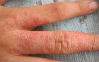 Аллергические высыпания на коже у взрослых