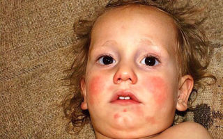 Аллергия от арбуза