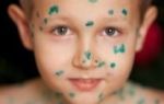 Как выглядит аллергия на коже у ребенка