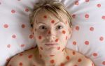 Аллергия на цинковую мазь