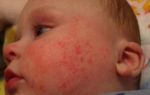 Аллергический дерматит у детей симптомы
