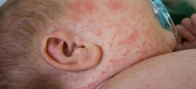 Крапивница симптомы