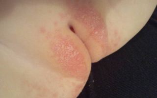 Аллергия на гениталиях