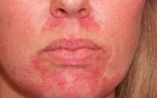 Аллергия вокруг рта у взрослого