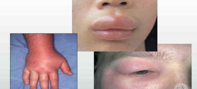 Первая помощь при аллергической реакции