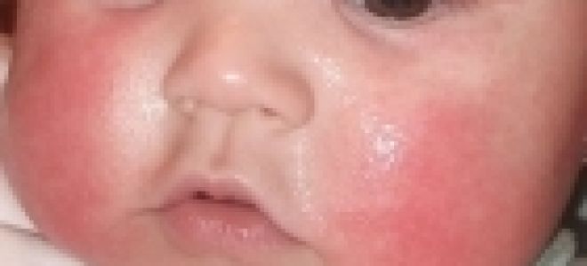 Что дать новорожденному от аллергии