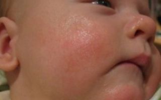 Сыпь при аллергии у взрослых