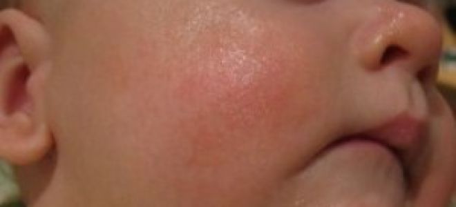 Сыпь при аллергии у взрослых