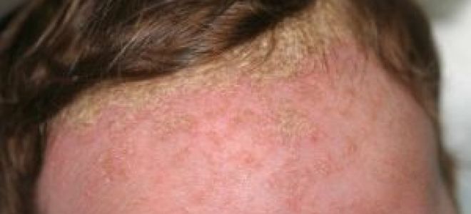 Себорейный дерматит заразен