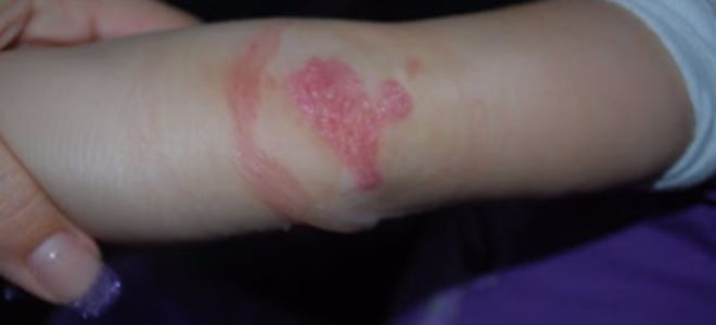 Чем подсушить мокнущую экзему