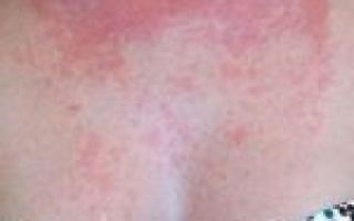 Аллергия на индейку у ребенка
