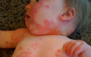 Что дать ребенку от аллергии |