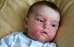 Аллергия на пот у ребенка