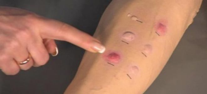 Пробы на аллергены у детей