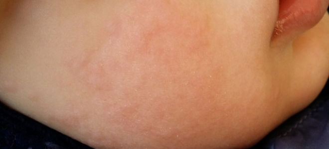Аллергическая реакция на лекарства симптомы