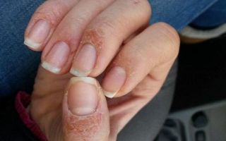 Аллергия на лампу для сушки ногтей