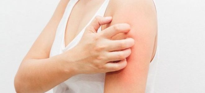 Сколько лечится крапивница