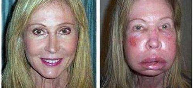 Как начинается отек квинке