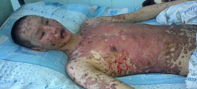 Признаки аллергии на коже