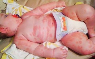 Сыпь на антибиотики у ребенка