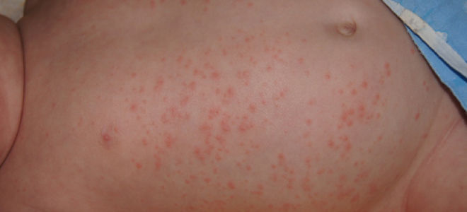 Аллергия на хлеб у ребенка