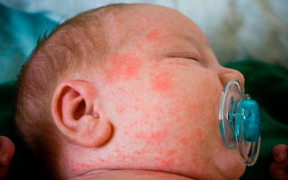 Аллергия на лице у новорожденного чем лечить
