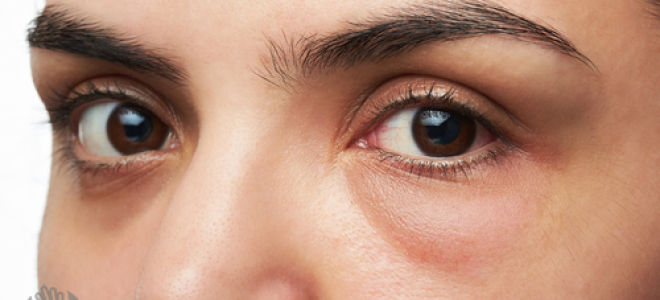 Чешутся глаза чем лечить