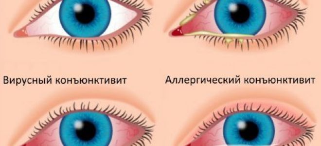Глазные капли при аллергии
