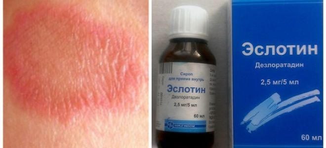 Аллергия у ребенка красные пятна на ногах