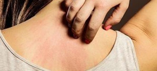 Аллергия на сладкое на лице