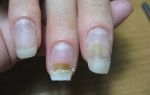 Аллергия на наращивание ногтей