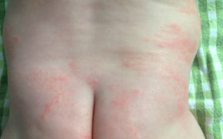 Чем лечить аллергию у грудничка на теле