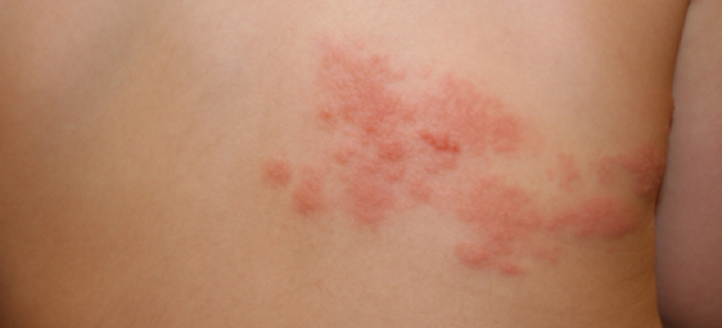 Чем лечить сыпь у ребенка