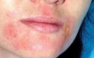 Аллергия на маску для лица