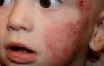 Как выглядит аллергия на коже