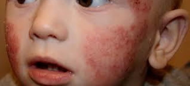 Как выглядит аллергия на коже