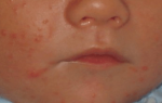 У новорожденного аллергия на лице что делать