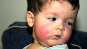 Аллергия на сыр у ребенка