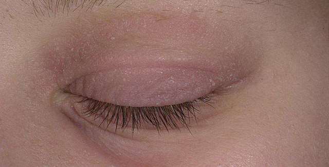 Аллергия глаз