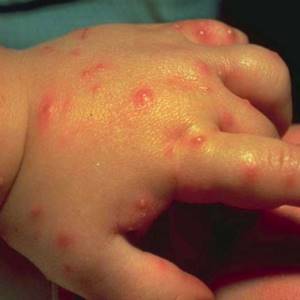 Аллергия на укус комара у ребенка