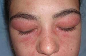 Аллергия на нарощенные ресницы что делать