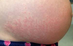 Аллергический дерматит при беременности