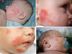 Аллергия на нестожен