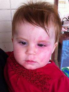 Аллергия на клубнику у ребенка
