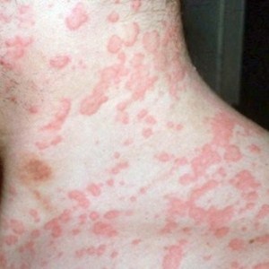Гель от аллергии на коже