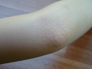 Аллергия на коленях и локтях