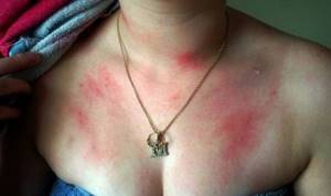 Аллергия на горячее