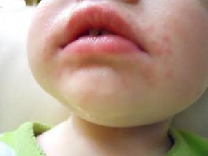 Аллергия на клубнику у ребенка
