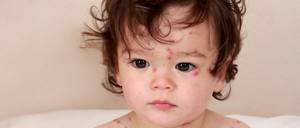 Аллергия на нурофен у ребенка чем лечить