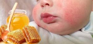 Аллергия от меда как проявляется